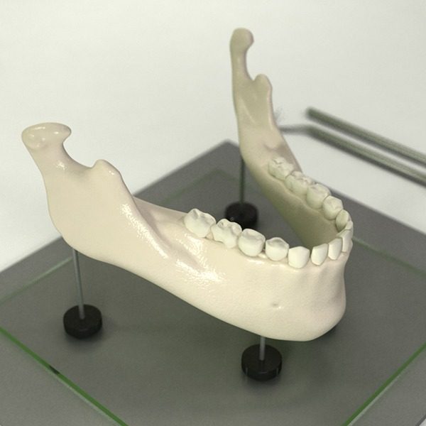 3D printing of a jawbone